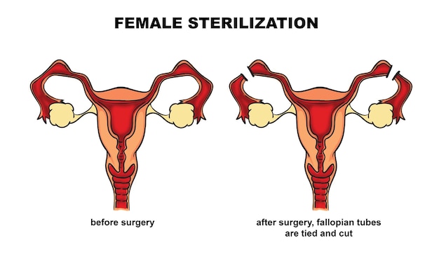 Ilustración digital de la esterilización femenina por corte de las trompas de Falopio procedimiento médico de salud