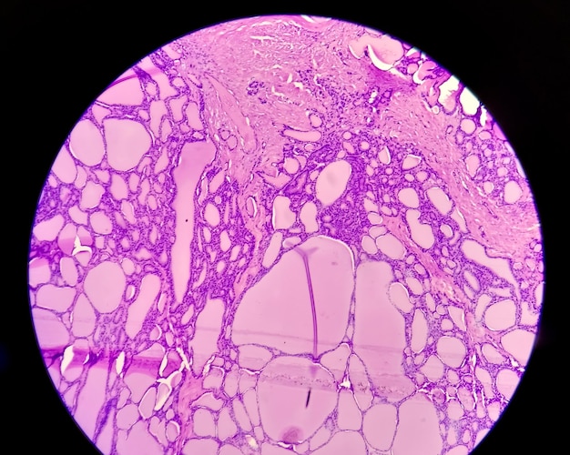 Imagem de histologia de sarcoma sinovial analisada por microscópio de luz no laboratório de histopatologia. Câncer.