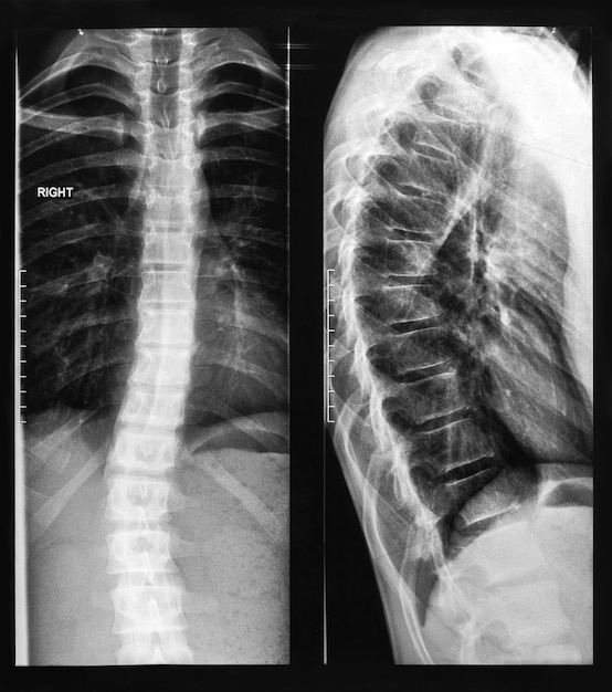 Imagem de raio x da coluna vertebral.