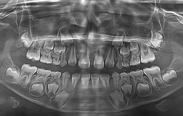Foto imagem de raio-x de dentes de uma criança
