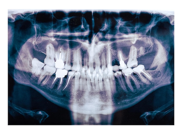 imagem de raio x dental infantil