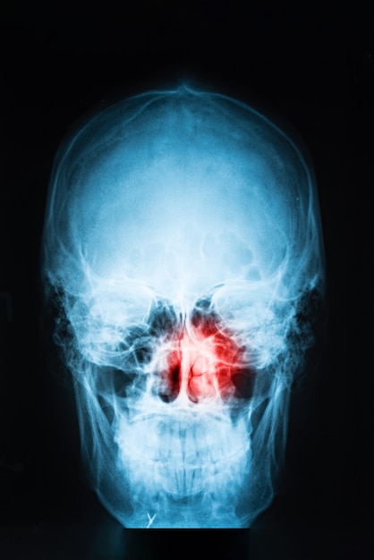 Imagem de raio-X do crânio com ponto vermelho de dor nos seios da face, conceito de sinusite, vertical, close-up