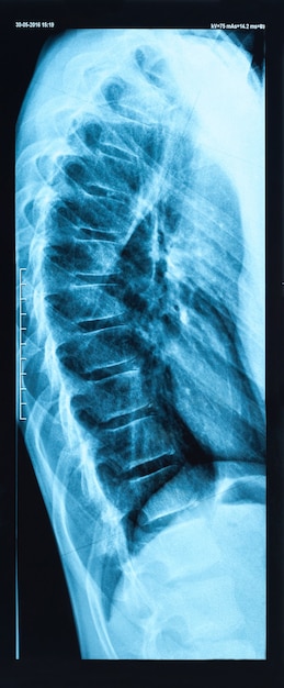 Imagem de raio-x lateral da coluna humana danificada.