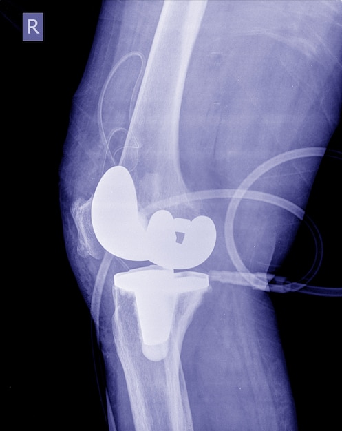 Imagem de raios-x pós operação joelho substituição total do joelho direito.