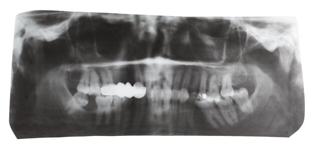 Imagem dental do raio X de maxilas humanas isoladas