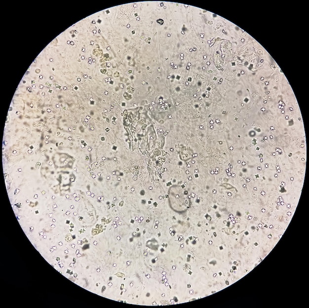 Imagem microscópica mostrando cristal de oxalato de cálcio e outros cristais urinários do sedimento urinário