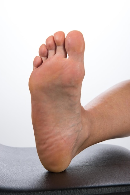 Imagem para fins médicos Calosidade plantar da pele seca e escamas na sola dos pés femininos close-up