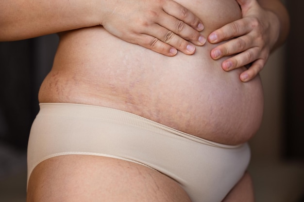 Imagem recortada mulher gorda com excesso de peso mão na barriga com estrias Ganho rápido de peso Corpo após o parto