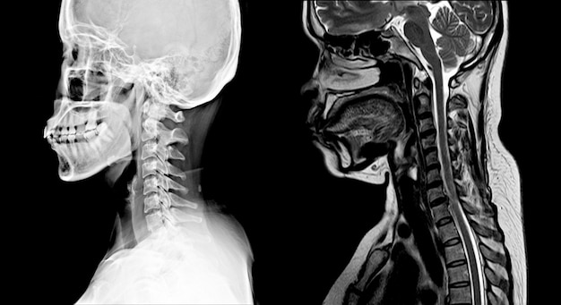 Imagen de la columna vertebral Radiografía normal y resonancia magnética: se muestra un estrechamiento del espacio discal C4-5 con erosión y esclerosis de las placas terminales