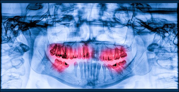 Foto imagen digital panorámica de rayos x dentales de la mandíbula superior e inferior escaneo radiográfico del maxilar y la mandíbala tomografía del plano focal