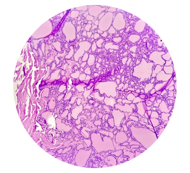 Imagen histológica del sarcoma sinovial analizada al microscopio en el laboratorio de histopatología. Célula cancerosa