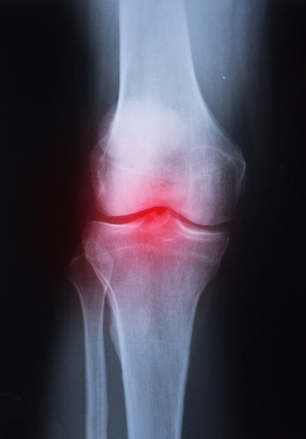 Imagen médica de la articulación de la rodilla por rayos X con artritis (gota, artritis reumatoide, artritis séptica