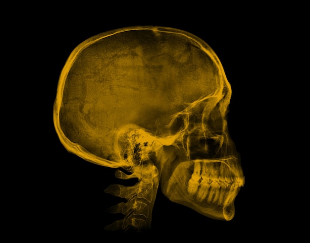 Imagen de rayos X amarillo cráneo humano sobre fondo negro