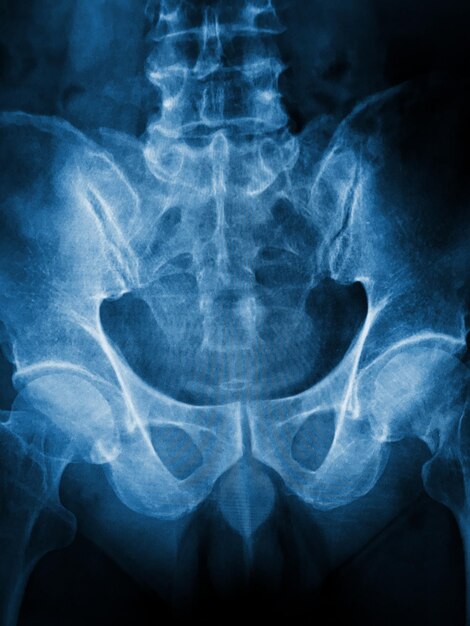 Una imagen de rayos x azul de una pelvis con la palabra xray en ella