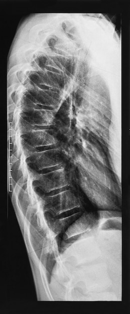 Foto imagen de rayos x de la columna vertebral