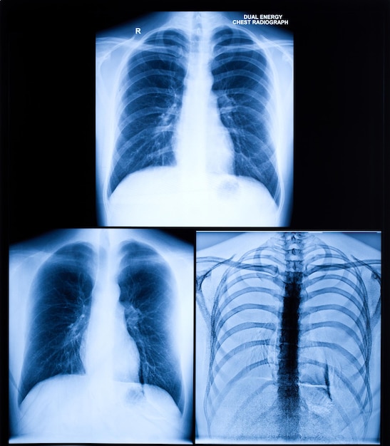 Imagen de rayos X del pecho humano