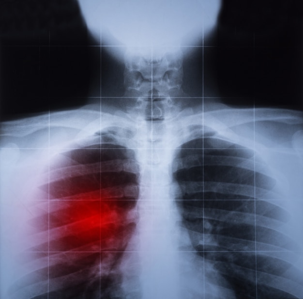 Imagen de rayos X del tórax y enfermedad pulmonar resaltada en rojo.