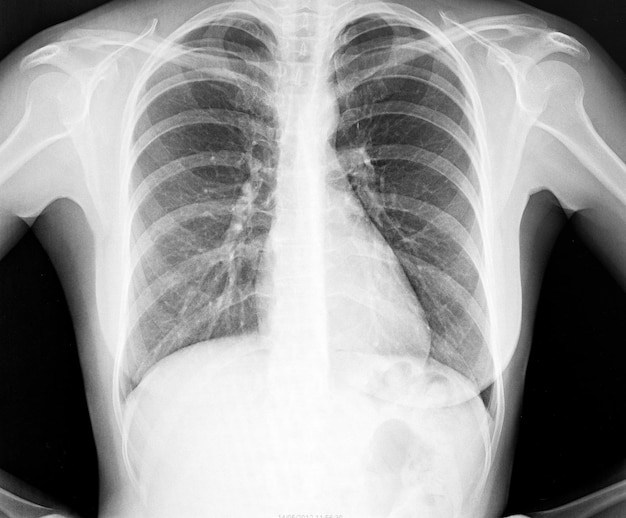 Imagen de rayos X del tórax humano para un diagnóstico médico
