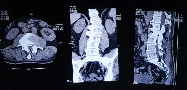 Imagen de TC de la columna con escoliosis y protrusión del disco intervertebral.