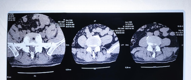 Imagen de TC de la columna vertebral de un paciente con escoliosis