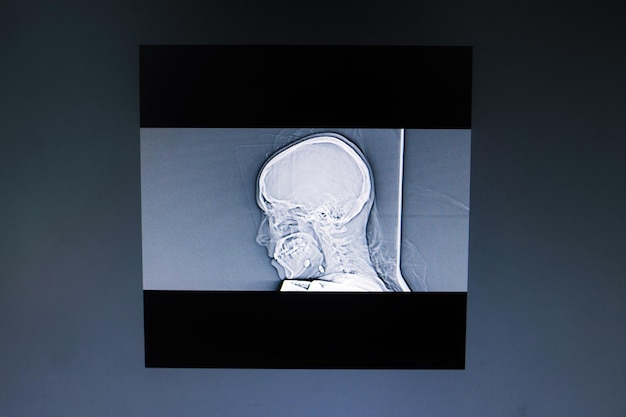 Imagen de tomografía computarizada del cerebro