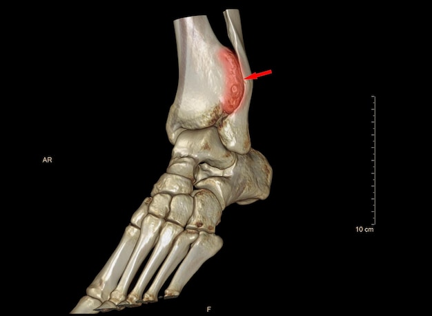 Las imágenes de renderizado 3D de rayos X y tomografía computarizada del tobillo revelan una anomalía del hueso de la tibia distal que es más grande que el peroné distal