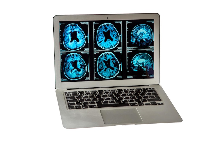 Foto imágenes por resonancia magnética del cerebro humano en una pantalla de computadora para el diagnóstico médico neurológico de enfermedades del cerebro humano