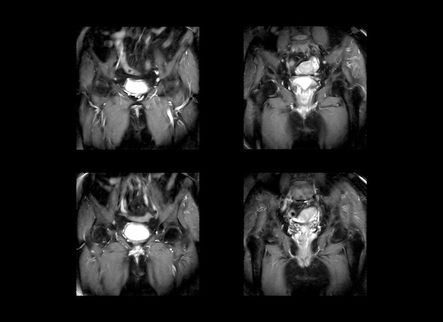 Imagens de ressonância magnética de quadril e pélvica e tomografia computadorizada