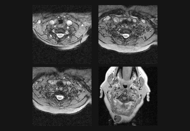 Imagens profissionais de ressonância magnética da coluna cervical e tomografia computadorizada (TC)