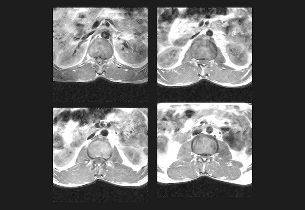 Imagens profissionais de ressonância magnética e tomografia computadorizada (tc) da coluna dorsal