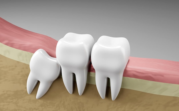 Impactación de la muela del juicio Salud bucal y dientes de inspección dental Dentista médico