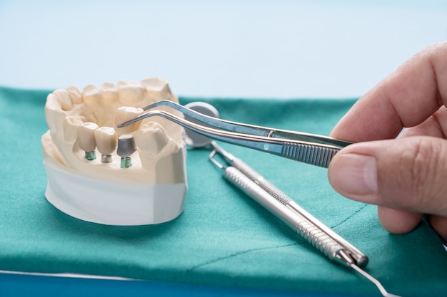 Implan modelo de soporte dental para fijar puente implan y corona.