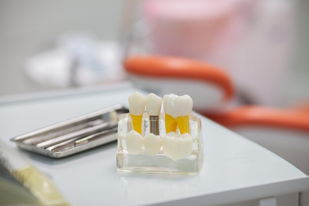 Implantatmodell und Zahninstrumente auf dem Tisch in der Zahnarztpraxis