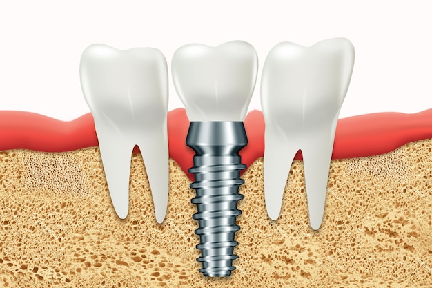 Implante dental, poste de encía inoxidable