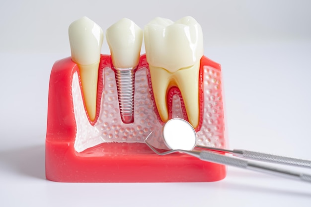 Implante dental raíces de dientes artificiales en el conducto radicular de la mandíbula del tratamiento dental enfermedad de las encías modelo de dientes para dentista que estudia sobre odontología