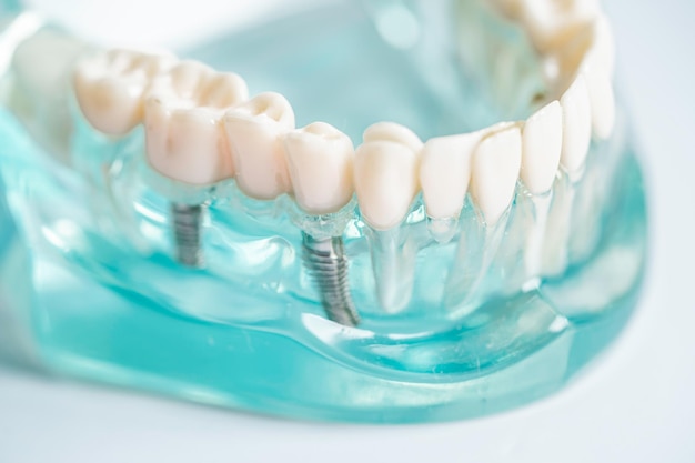 Implante dental raíces de dientes artificiales en el conducto radicular de la mandíbula del tratamiento dental enfermedad de las encías modelo de dientes para dentista que estudia sobre odontología