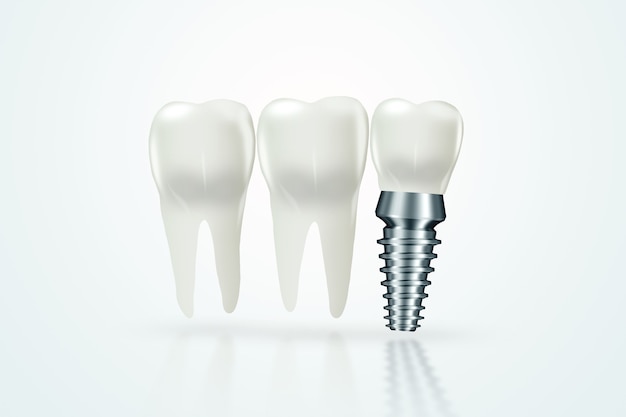 Implante dentário, pino de goma inoxidável