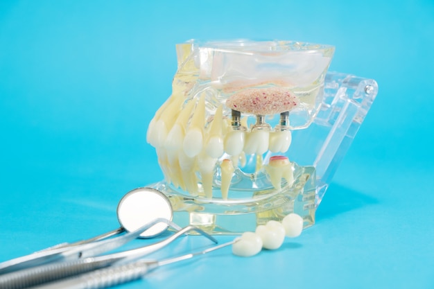 Implante e modelo ortodôntico para o aluno ao modelo de ensino-aprendizagem mostrando os dentes.