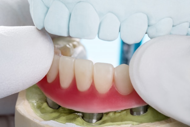 Foto implantes dentales soportados sobredentadura.