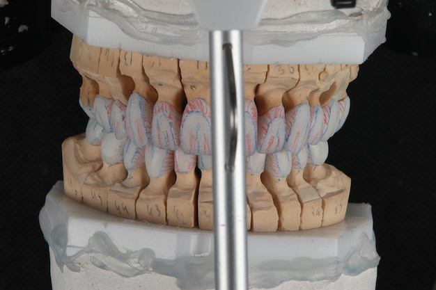 Foto implantes dentários