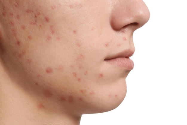 Foto indivíduo adolescente com problema da acne no close up branco do fundo