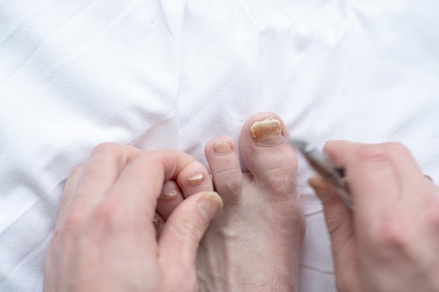 Foto infección fúngica en las manos, las piernas, el dedo con onicomicosis cuidado y tratamiento primer plano de un pie con uñas dañadas debido al hongo