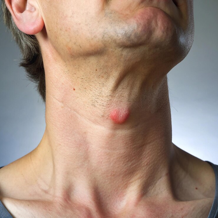 Inflamación de la tiroides en el cuello Imágenes detalladas y síntomas