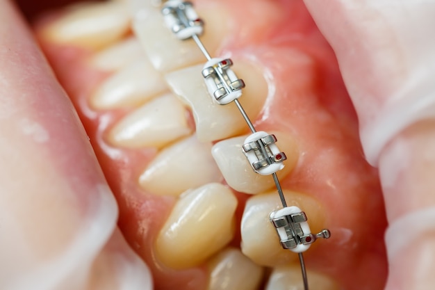 Instalação de aparelho nos dentes. tratamento odontológico ortodôntico. close dos dentes com aparelho. foto de alta qualidade