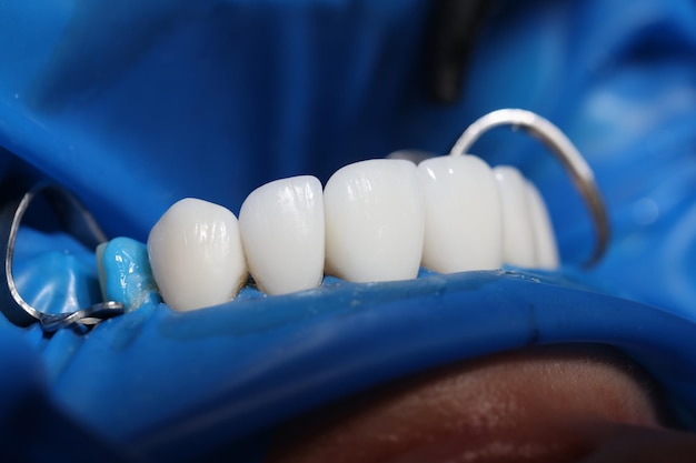 Instalación de carillas e implantes dentales en primer plano de la clínica