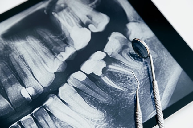 Instrumentos dentales y radiografía de la mandíbula en la mesa blanca Radiografía digital panorámica de la mandíbula en el fondo blanco de la tableta
