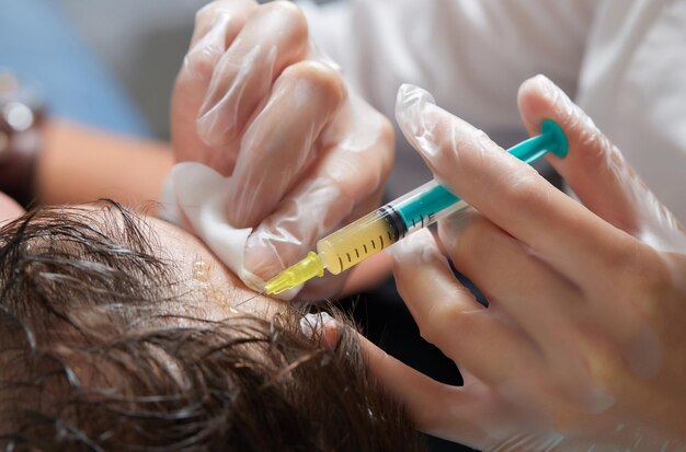 Inyección de plasma en el cabello de la cabeza hombre cosmetólogo médico