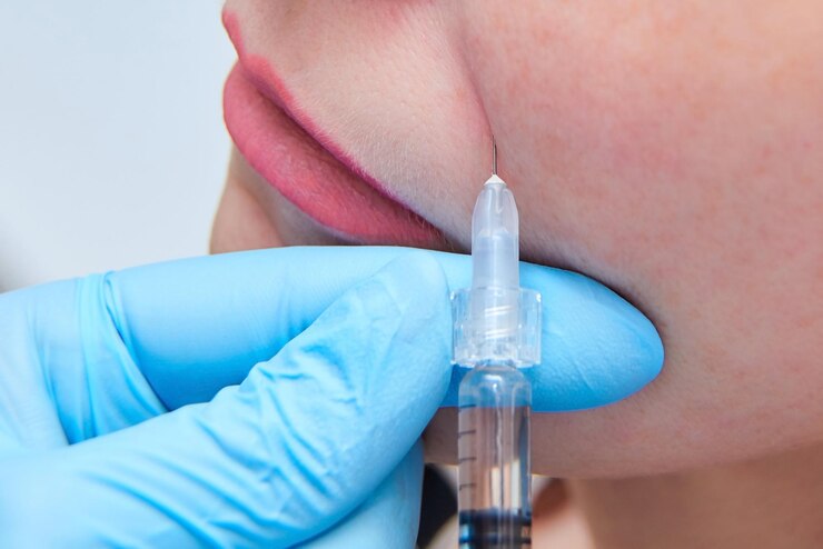 Inyección de plástico de contorno de cosmetología Rellenado del pliegue nasolabial con preparación con ácido hialurónico