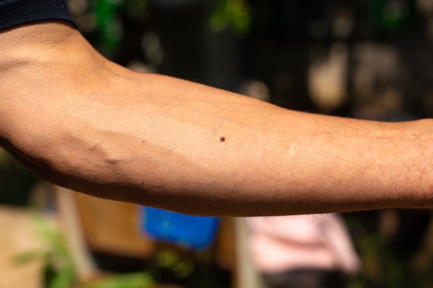 Ixodid blutsaugende Zecke an der Hand. Gehen Sie im Frühling im Park spazieren. Gefährliche Insekten.