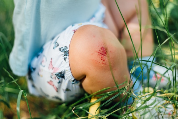 Joelho de bebê com arranhão sangrento. Dia de verão na grama. Problema da criança